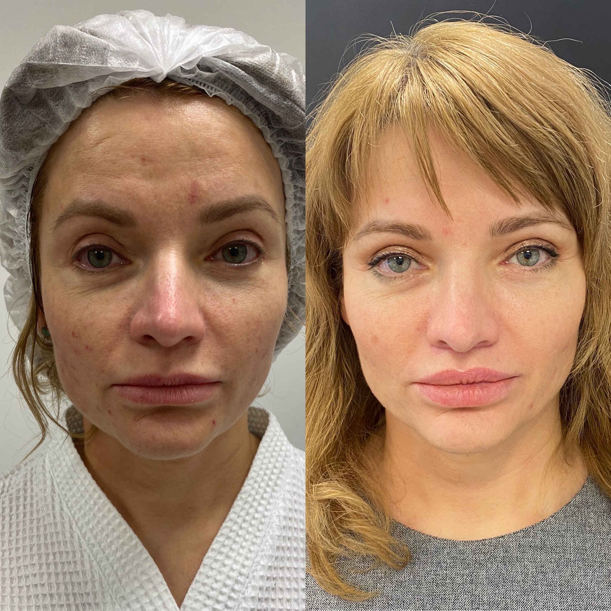 операция булхорн фото до и после